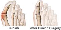 Bunion Removal Surgery NYC image 1